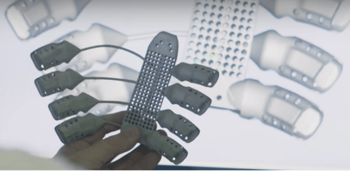 3D Printed Ribs From Anatomics For A Cancer Patient